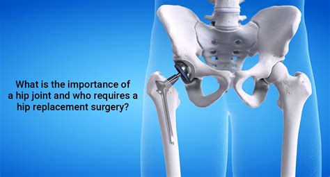 hip replacement surgery greenwich